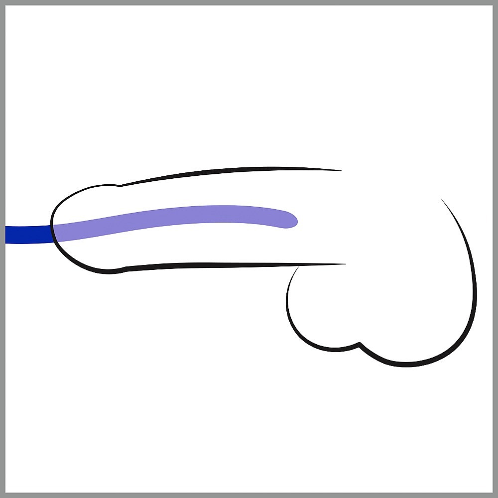 Silicone Dilator set